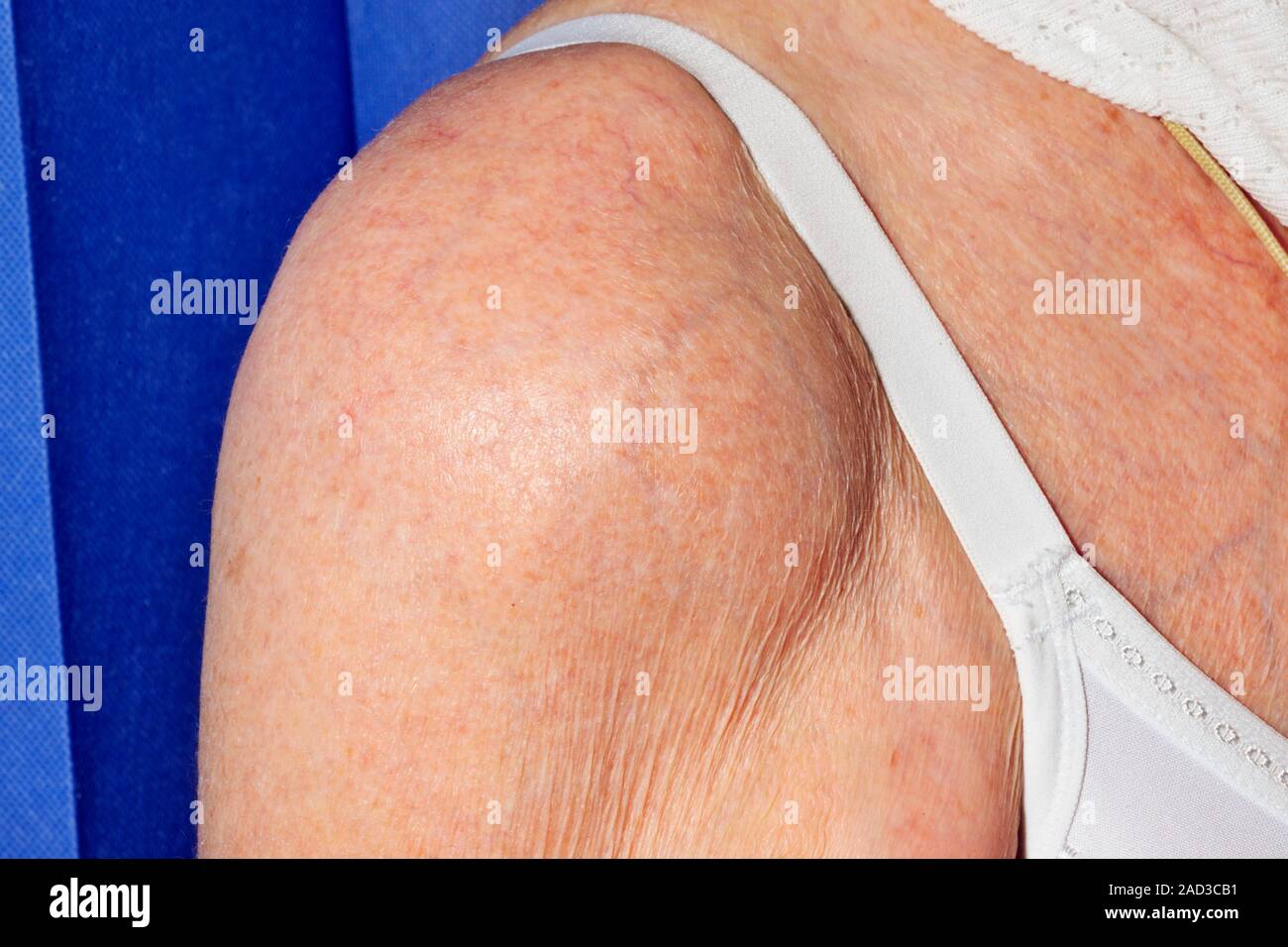 Spalla gonfia dopo la lussazione. Close-up della spalla gonfia di un 77-anno-vecchio paziente femmina con effusione (accumulo di liquido) seguenti disl Foto Stock