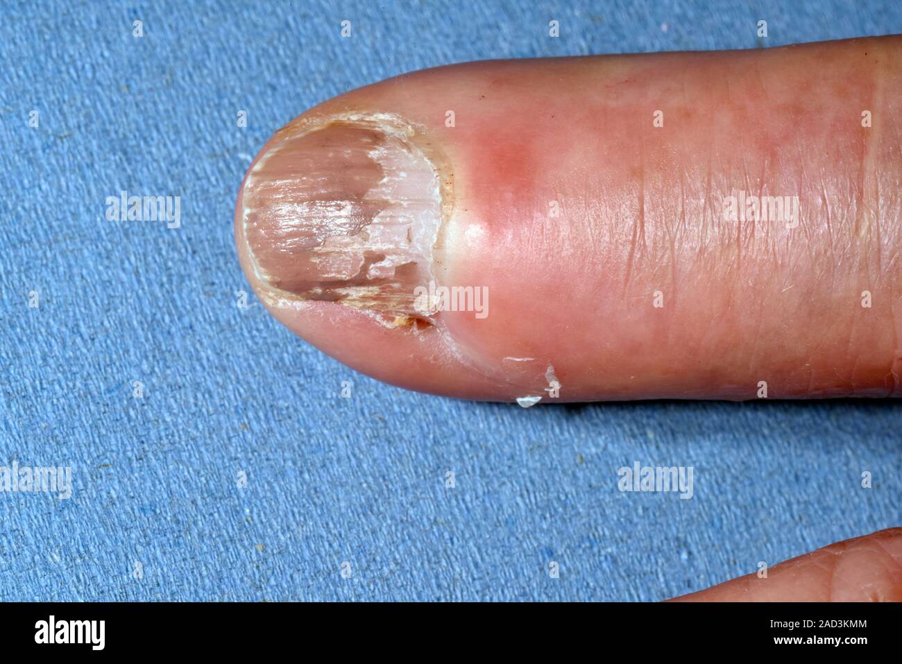 Dito infetta ferita. Close-up del fingertip gonfia di un 77-anno-vecchio paziente di sesso femminile che si sia infettato in seguito ad una lesione dove un vetro fr Foto Stock