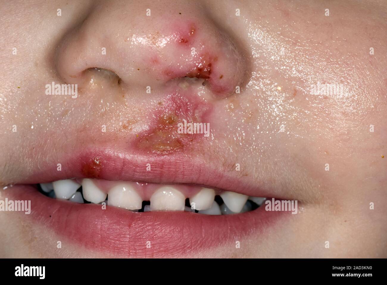 Impetigo sulla faccia. Close-up di una eruzione cutanea sulla faccia di un 3-anno-vecchio paziente femmina con impetigo. Impetigo è una pelle batterica infezione causata prima Foto Stock