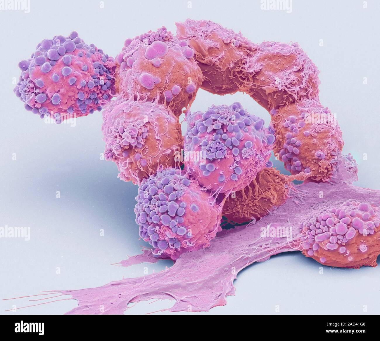 Brain cancer cellule. Color scanning electron microfotografia (SEM) di cellule cancerose da un oligodendroglioma. Oligodendrogliomas sono un tipo di tumore Foto Stock