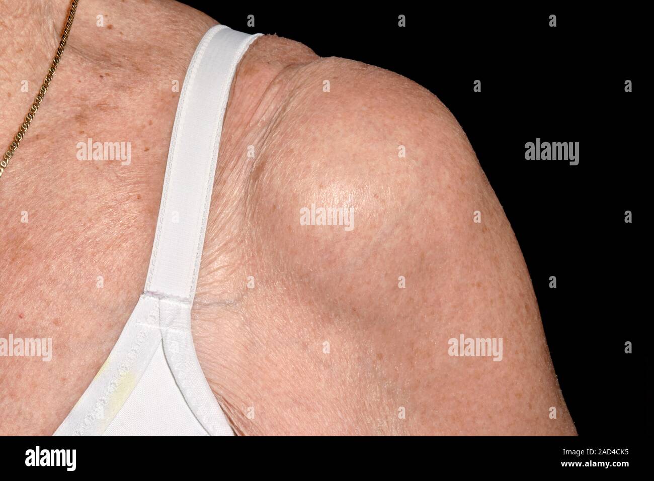 Effusione di spalla in osteoartrite. Close-up della spalla gonfia di un 86-anno-vecchio paziente di sesso femminile affetti da effusione causato da una grave osteoarth Foto Stock