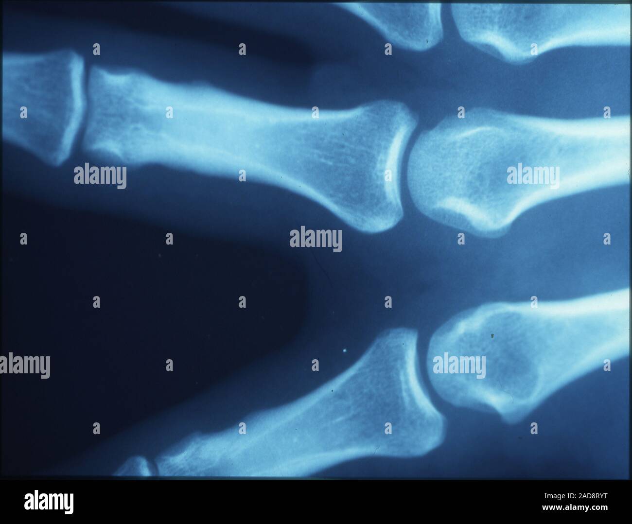 X-ray di immagine delle ossa delle dita con giunti Foto Stock