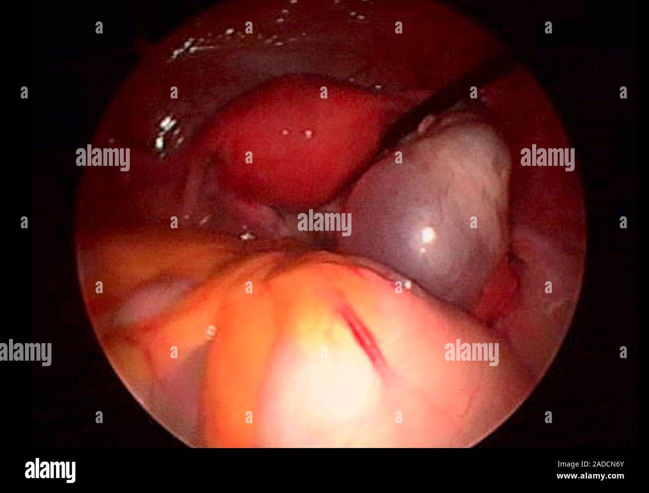 Cisti ovarica (a destra), endoscopio vista. Una ciste un fluido-riempito sac. Cisti ovariche sono comuni nelle donne in et fertile. Anche se molte le cisti sono essere Foto stock - Alamy Cisti ovarica (a destra), endoscopio vista. Una ciste un fluido-riempito sac. Cisti ovariche sono comuni nelle donne in et fertile. Anche se molte le cisti sono essere Foto stock - Alamy