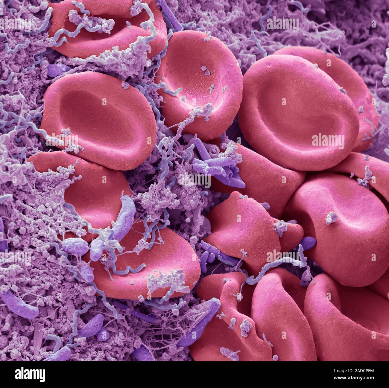 Il sanguinamento delle gengive. Micrografia al microscopio elettronico a  scansione (SEM) di sangue dalle gengive sanguinanti che mostra i batteri  della placca e cellule di sangue rosse (rosa). La causa principale di