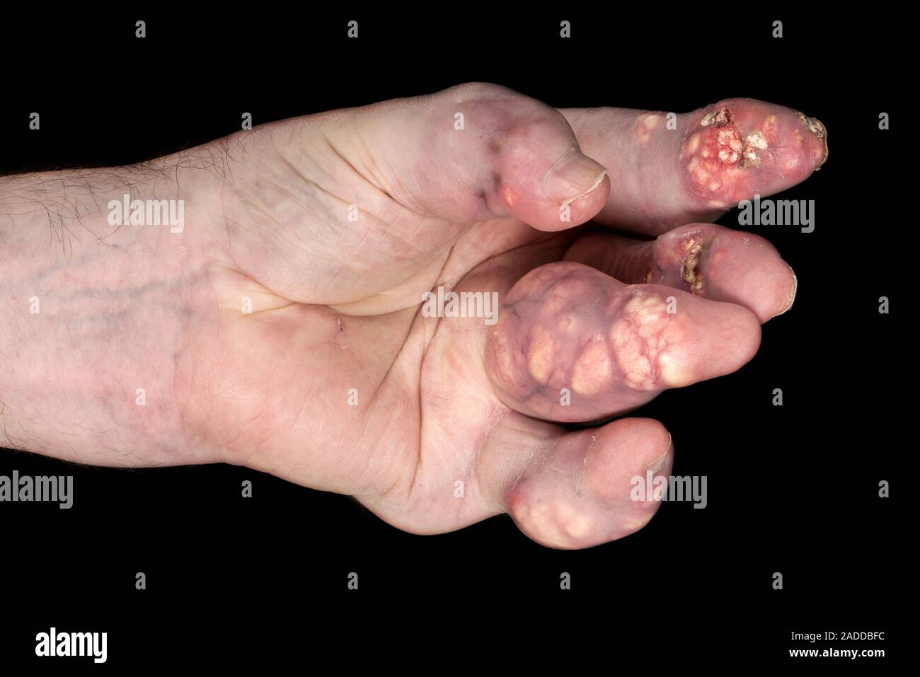 Gotta gravi che colpiscono la mano. Più tophi (rigonfiamenti) sulle dita della mano sinistra di un 57-anno-vecchio uomo con grave gotta. La gotta è un disturbo o Foto Stock