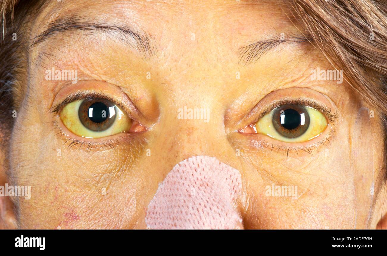Anelli Kayser-Fleischer negli occhi a causa di malattia del fegato. Occhi di  un 62-anno-vecchia donna con anelli Kayser-Fleischer (KF anelli) e  ingiallimento della pelle e degli occhi du Foto stock - Alamy