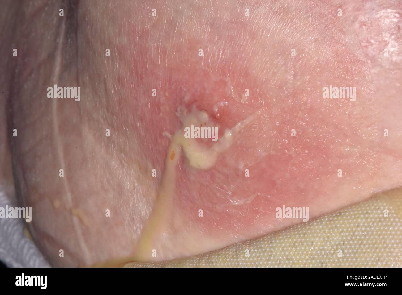 Modello rilasciato. Svuotamento di un ilio-psoas ascesso in un 78-anno-vecchia ragazza. Un psoas (o ileopsoas) ascesso è una raccolta di pus nel muscolo ileopsoas c Foto Stock