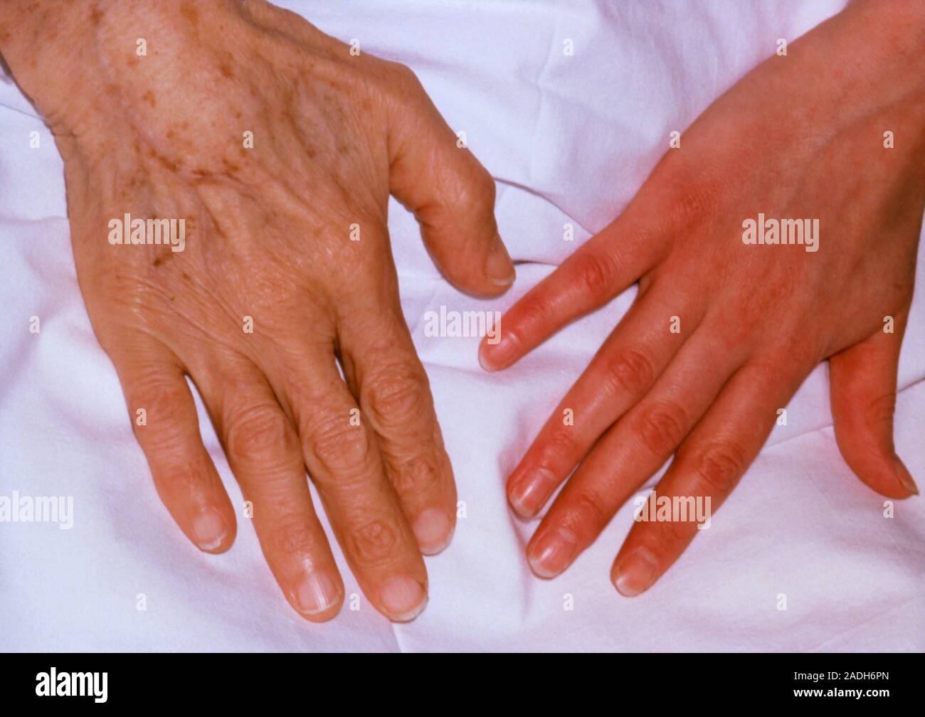 La pallida pelle della mano di un paziente con anemia da deficienza di ferro (sinistra) è confrontato con il sano, pelle rosa di un normale della mano (destra). Anemia Foto Stock