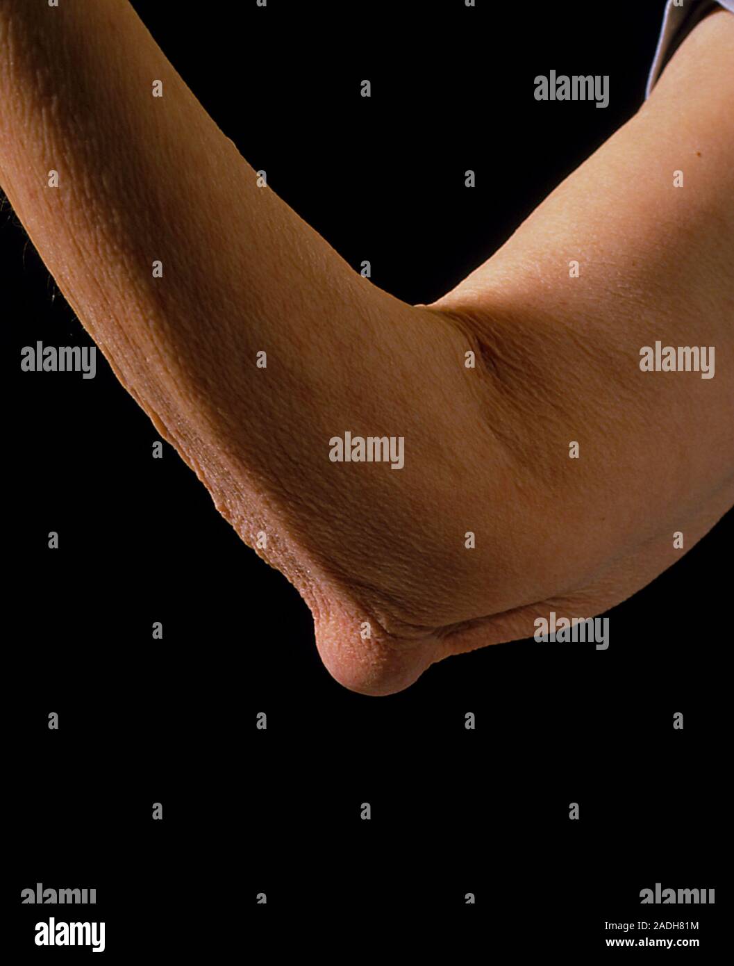 Artrite reumatoide. Nodulo reumatoide visto sul braccio di un paziente anziano a causa di artrite reumatoide. Questa morbida nodulo è formata in risposta a p Foto Stock