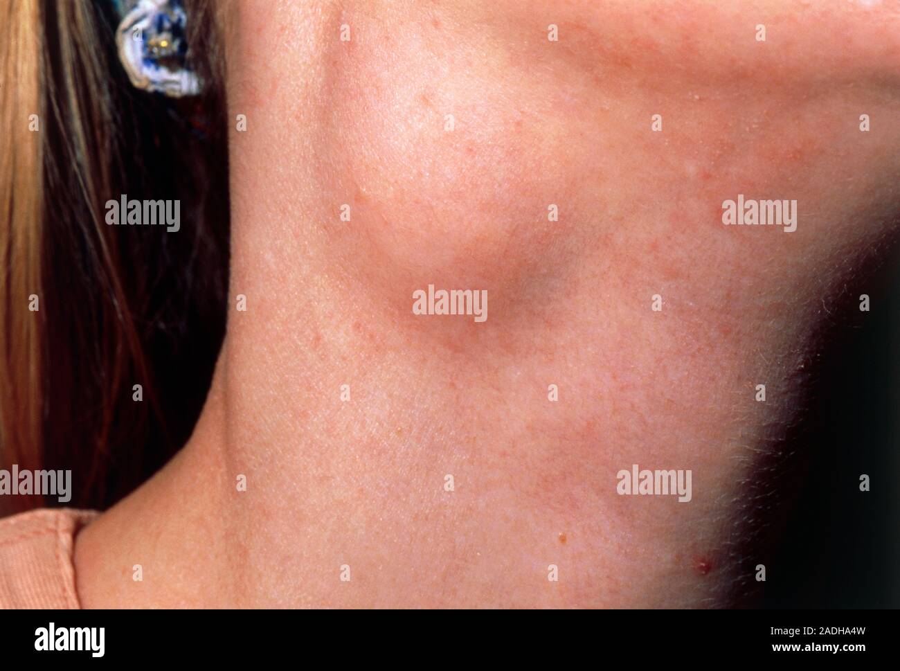 Cisti brachiale. Close-up del rigonfiamento derivante da una ciste  brachiale nel collo di un 30-anno-vecchia ragazza. Disturbi brachiale  risultato dalla anormale Foto stock - Alamy