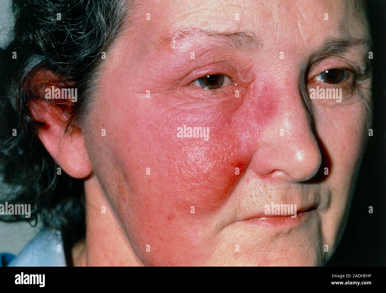 Erysipelas sul viso. Close-up di gonfi e infiammazioni cutanee sulla  guancia destra di una donna. Questo è dovuto alla erisipela, una infezione  acuta della pelle & s Foto stock - Alamy