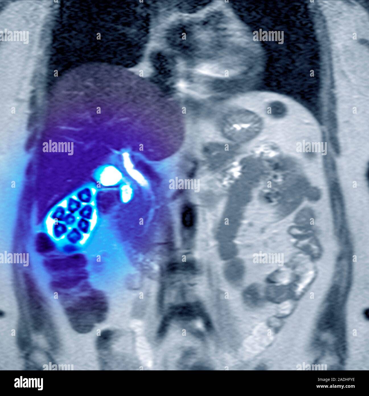 Calcoli biliari. Colorato imaging a risonanza magnetica (RM) scansione  della vista frontale di calcoli biliari (blu grumi, sinistra) nella  cistifellea (bianco), una conditio Foto stock - Alamy