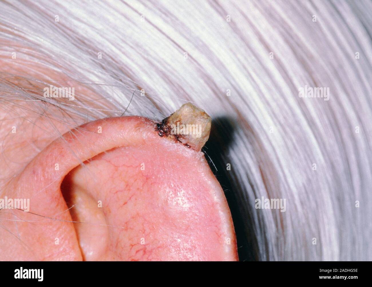 Corno cutaneo che cresce su una persona anziana l orecchio. Tali corna  derivano da una sovracrescita della pelle proteina cheratina. Essi sono una  crescita lenta e possono variare Foto stock - Alamy