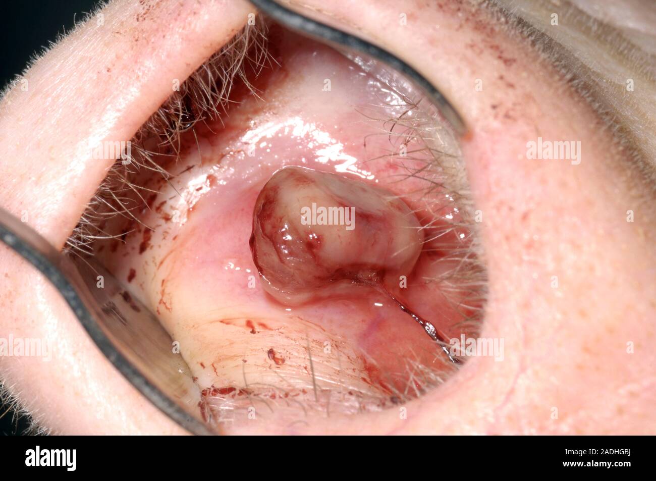 Ulcerata emangioma nel naso di un 86 anno vecchia donna. Si tratta di un  benigno (non cancerosi) il tumore dei capillari. Ulcerazione è un comune  complica Foto stock - Alamy