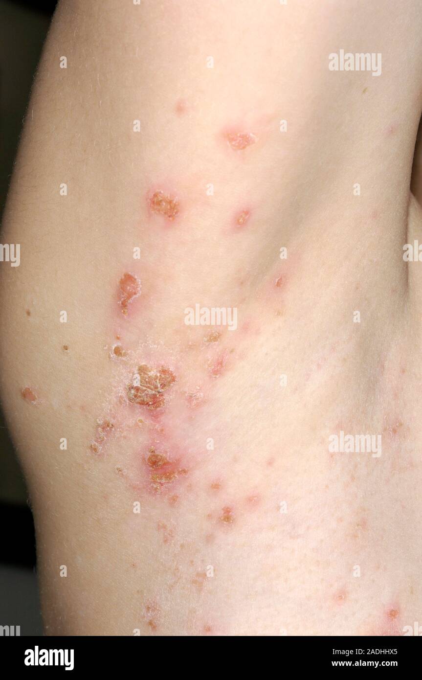 Rash Impetigo su un 8 anno vecchio ragazzo del ascelle. Impetigo è un batteriche infezioni della pelle causate da Staphylococcus aureus. Essa provoca la formazione di pustul Foto Stock