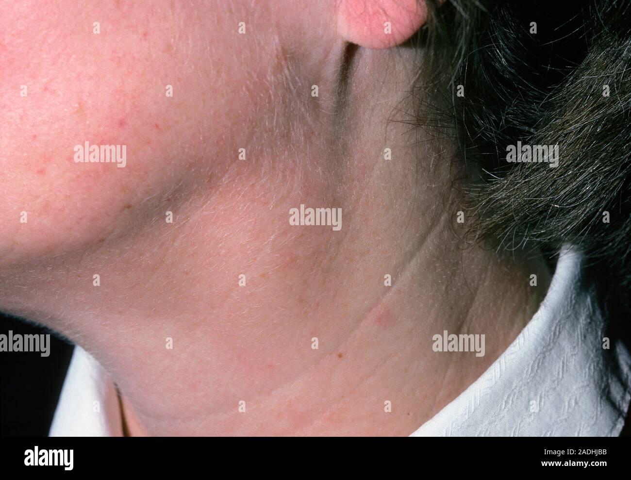 Linfoadenopatia. Ingrossamento delle ghiandole (linfoadenopatia) in una  donna di collo. Un rigonfiamento nella pelle è visibile sotto la  ganascia-linea. Ingrossamento delle ghiandole sono causati da mi Foto stock  - Alamy