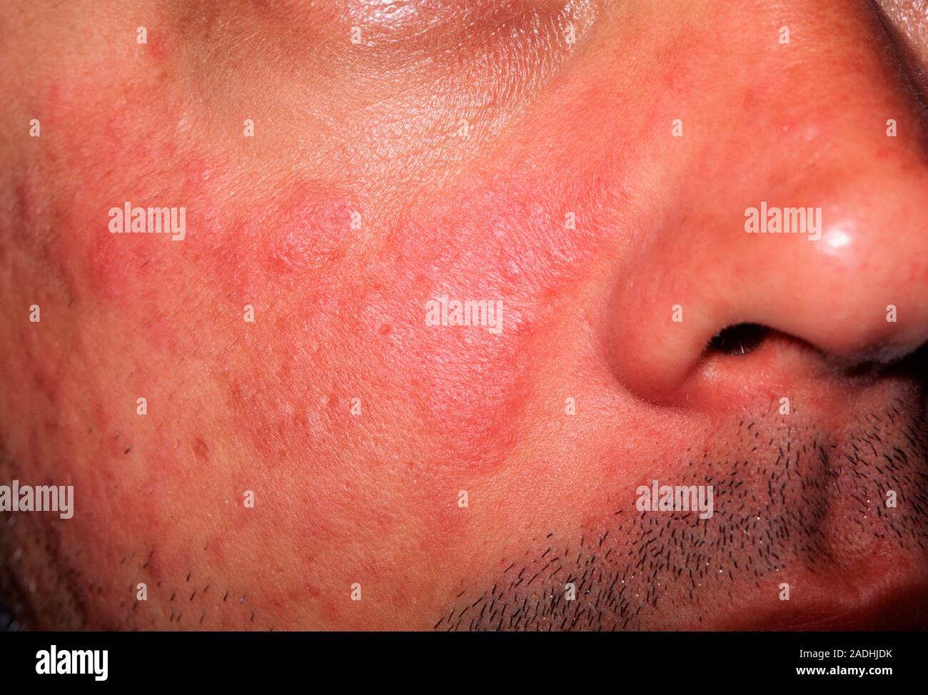 Il Lupus rash sulla guancia di un 35-anno-vecchio uomo. Egli ha il lupus  eritematoso sistemico (SLE), una forma della malattia autoimmune lupus. In  SLE il sistema immunitario s Foto stock - Alamy