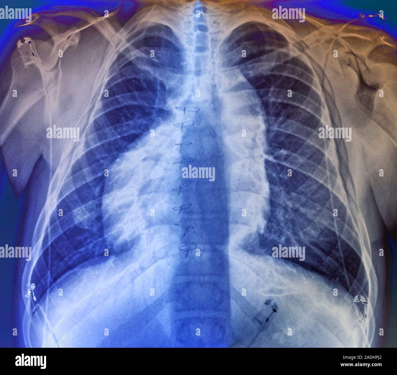 Organi invertiti. Frontale colorata X-ray di un 17-anno-vecchio paziente  con situs inversus totalis ("completamente disposizione invertita'). Questo  ereditato condi Foto stock - Alamy