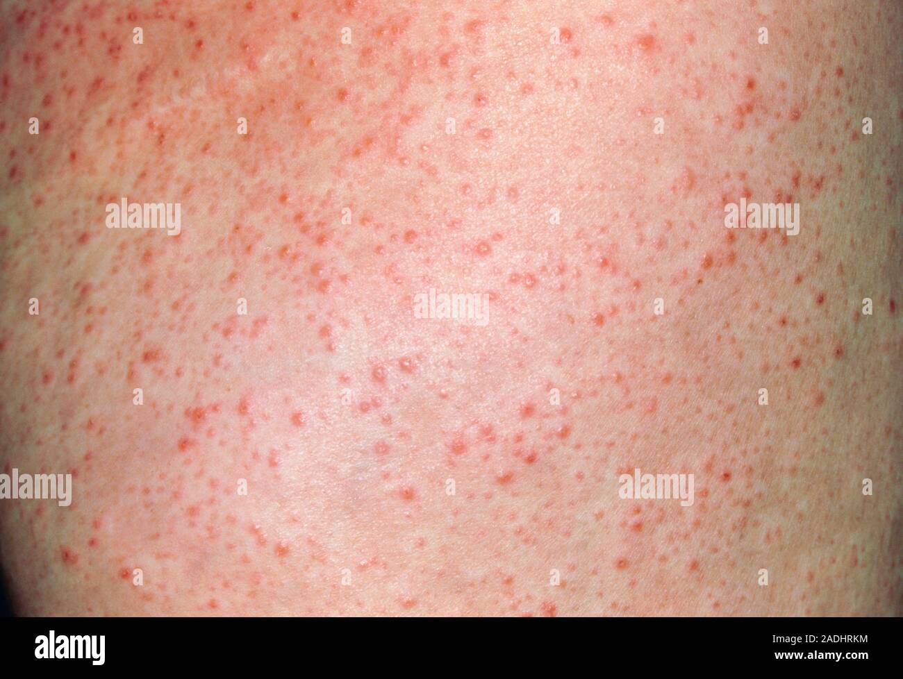 Reazione allergica a crema cosmetica. Una eruzione cutanea rossa sul corpo  di un 49-anno-vecchia donna causata da allergia a anti-cellulite crema  cosmetica. Questa reazione Foto stock - Alamy