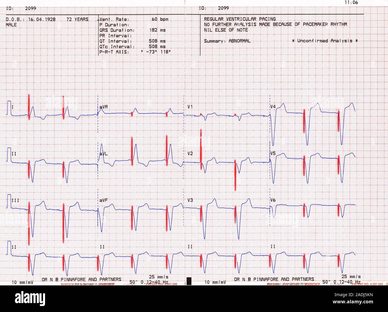 Pacemaker cardiaco. Elettrocardiogramma (ECG) che mostra il battito cardiaco di un 72-anno-vecchio uomo dotato al suo interno di un pacemaker artificiale. Questo alimenta regula Foto Stock