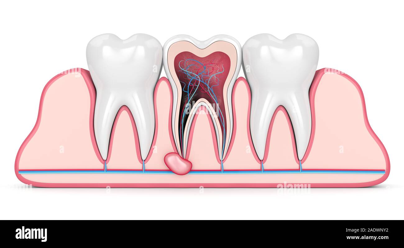 3D render di denti con gomme cisti. Problema dentale concetto. Foto Stock