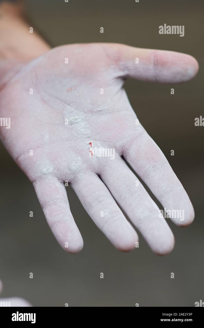 Mano del ginnasta bianco gesso in polvere contro uno sfondo scuro. Atleta ottenere pronto per l'allenamento con il sangue sulla mano. Foto Stock