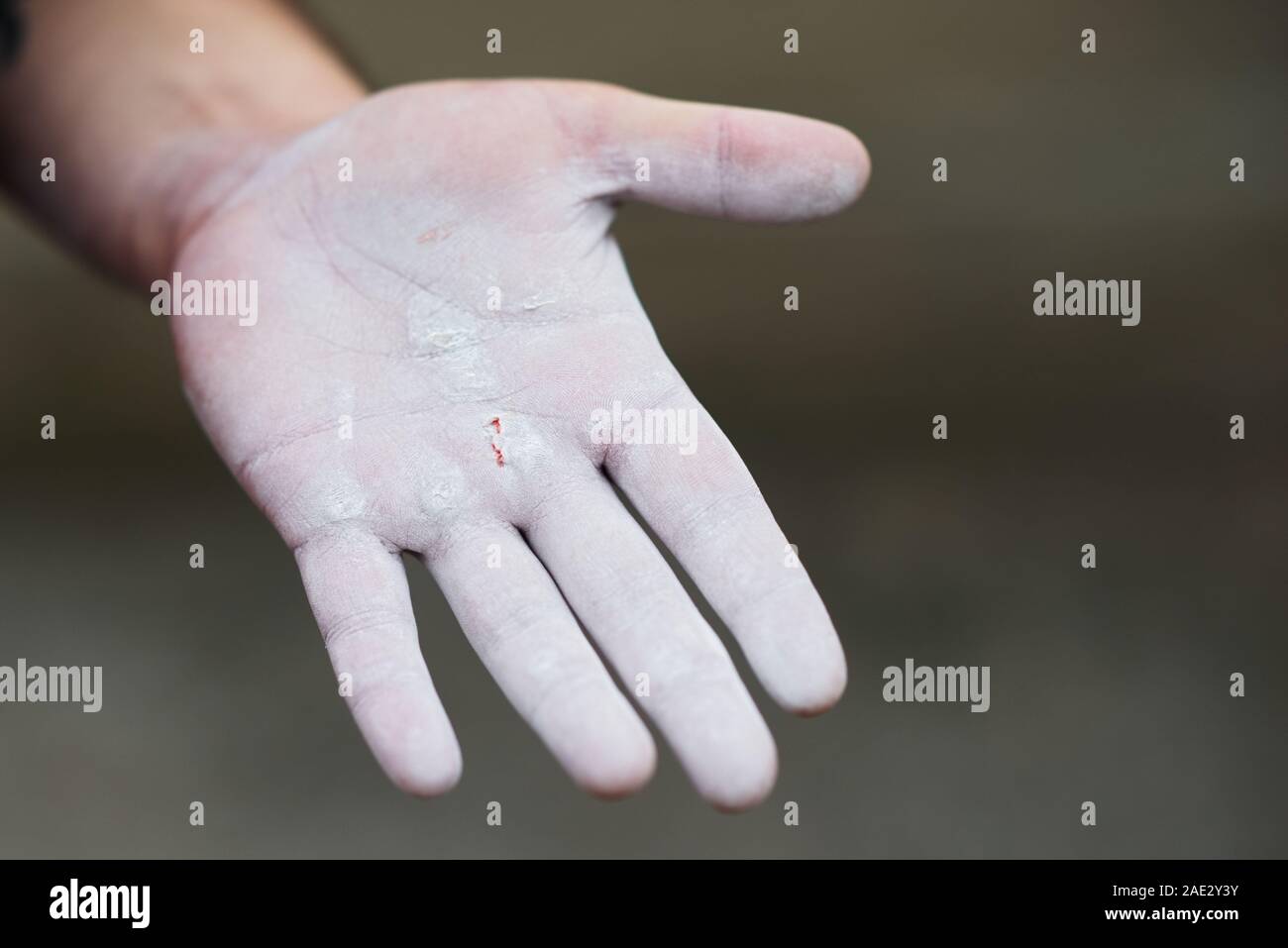 Mano del ginnasta bianco gesso in polvere contro uno sfondo scuro. Atleta ottenere pronto per l'allenamento con il sangue sulla mano. Foto Stock