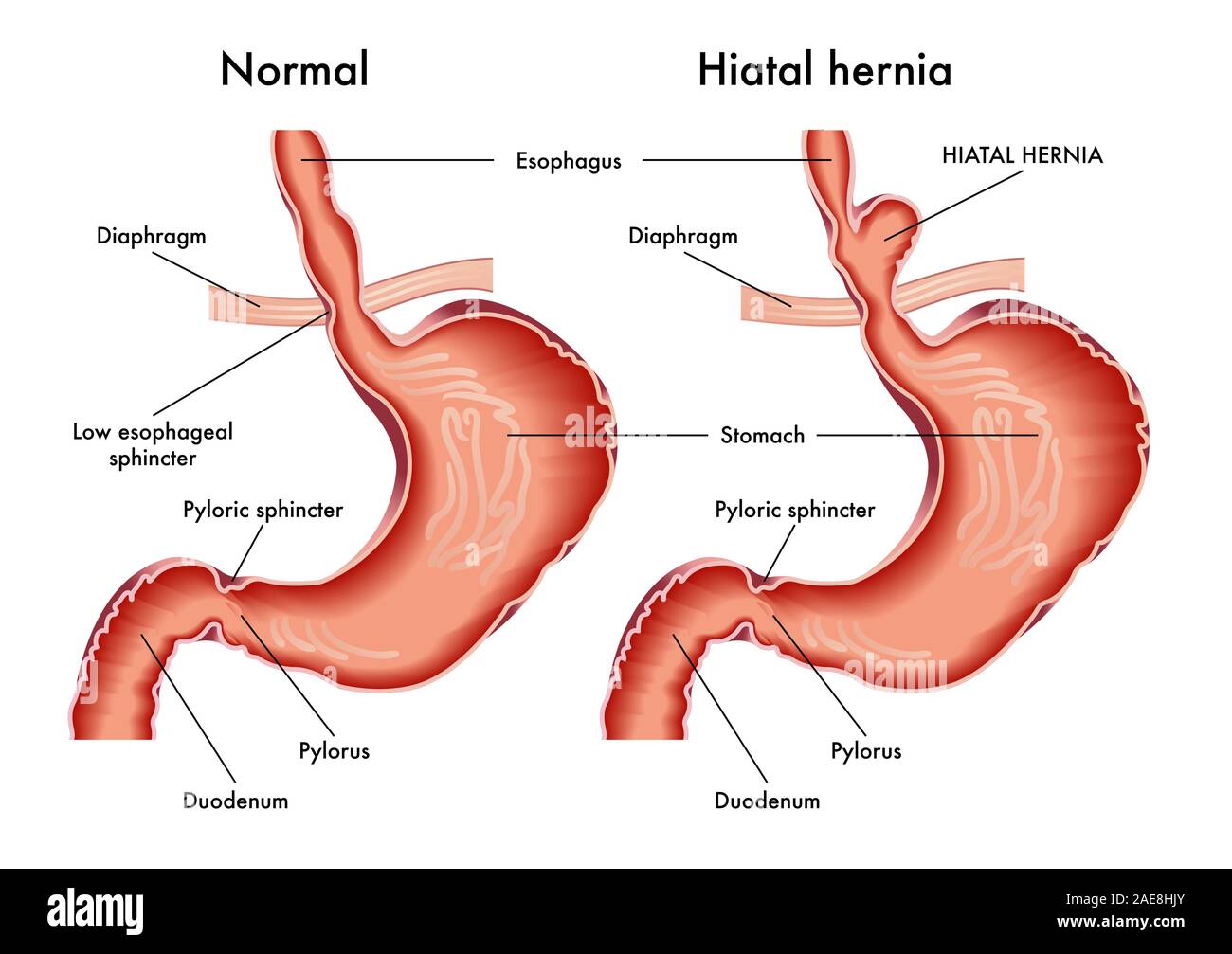 Illustrazione medica dello stomaco con un'ernia iatale con annotazione. Foto Stock
