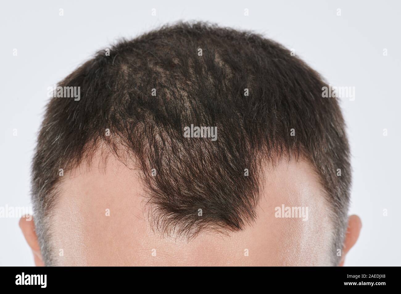 Danneggiato capelli uomo. Vuoto posto in grassetto sulla testa vista ravvicinata Foto Stock