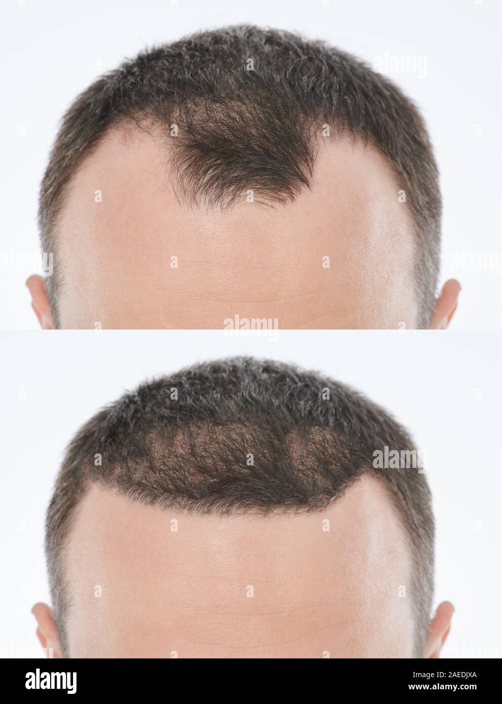 Bold problema di trattamento. Uomo prima e dopo capelli procedura di ripristino Foto Stock