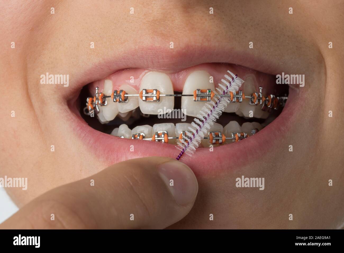 Close up di pulizia bretelle dentali con un filo interdentale spazzola Foto Stock