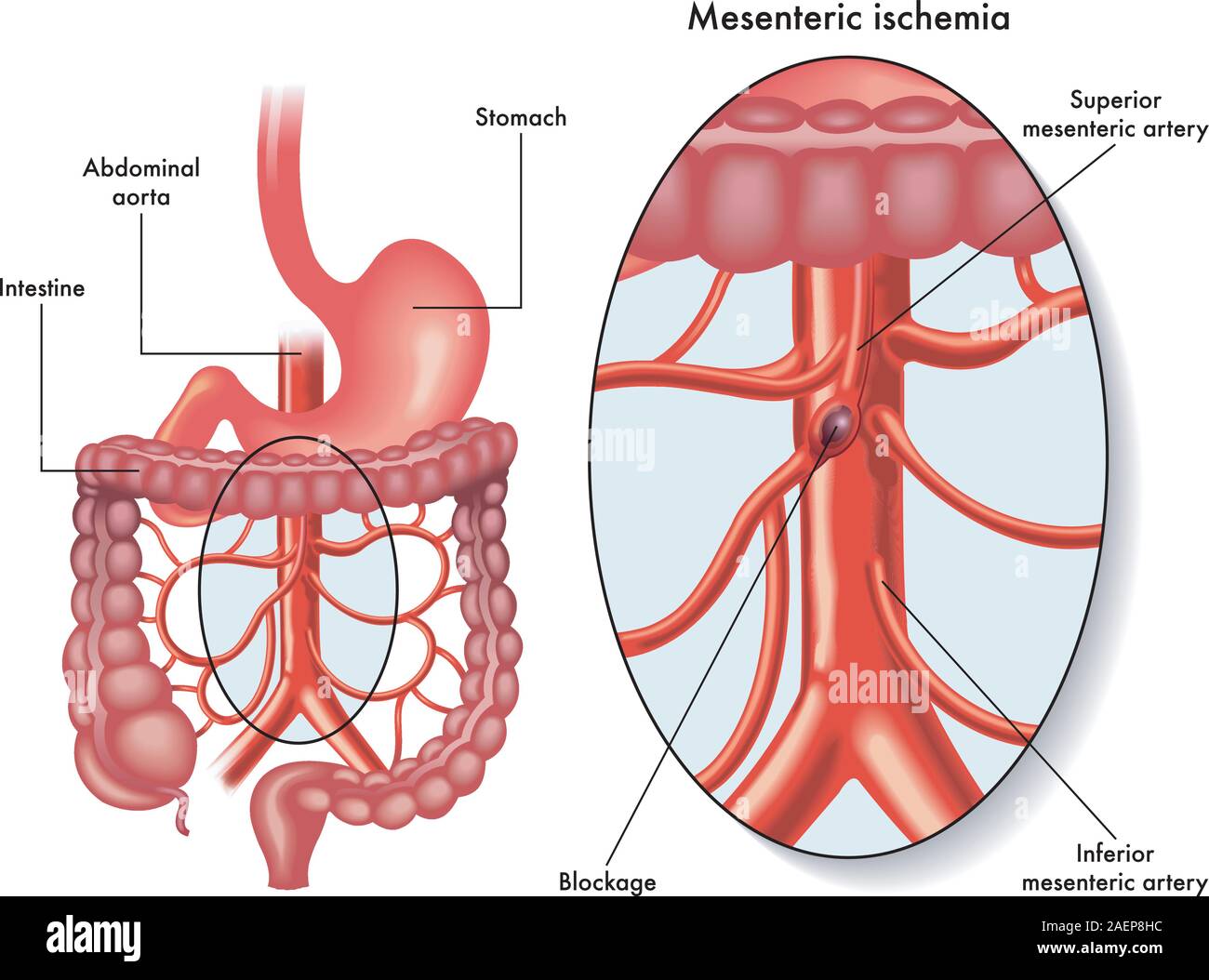 Medical illustrazione che mostra una ischemia mesenterica anche chiamato infarto intestinale, un blocco della circolazione del sangue, che colpisce il mesenterici di arte Illustrazione Vettoriale