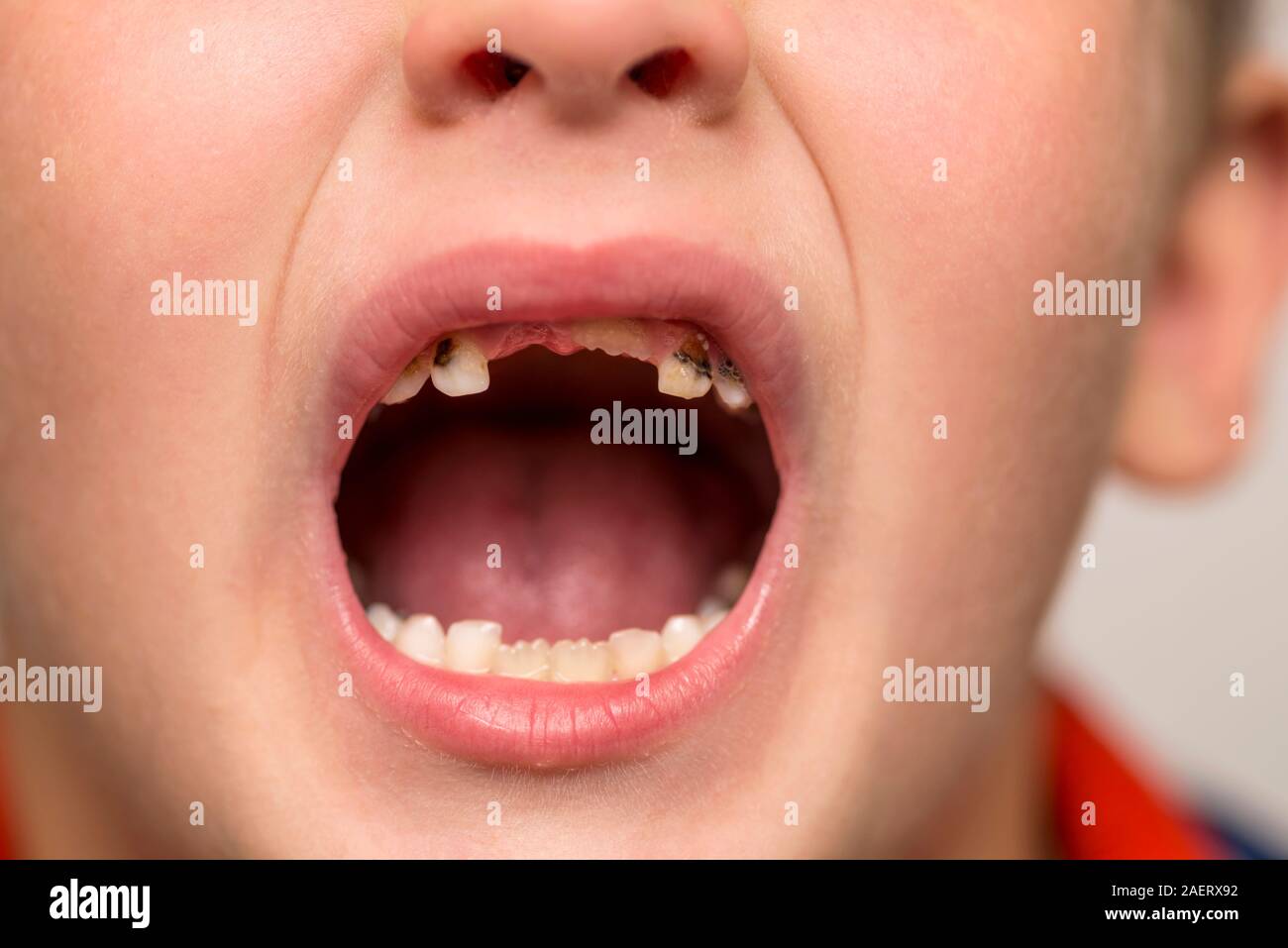 Open mouth showing caries teeth immagini e fotografie stock ad alta  risoluzione - Alamy