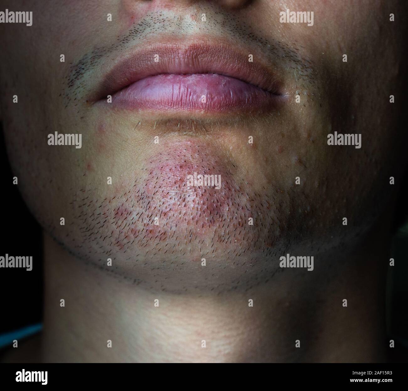 Rasoio, rash di rasatura su un giovane il volto dell'uomo. Foto Stock