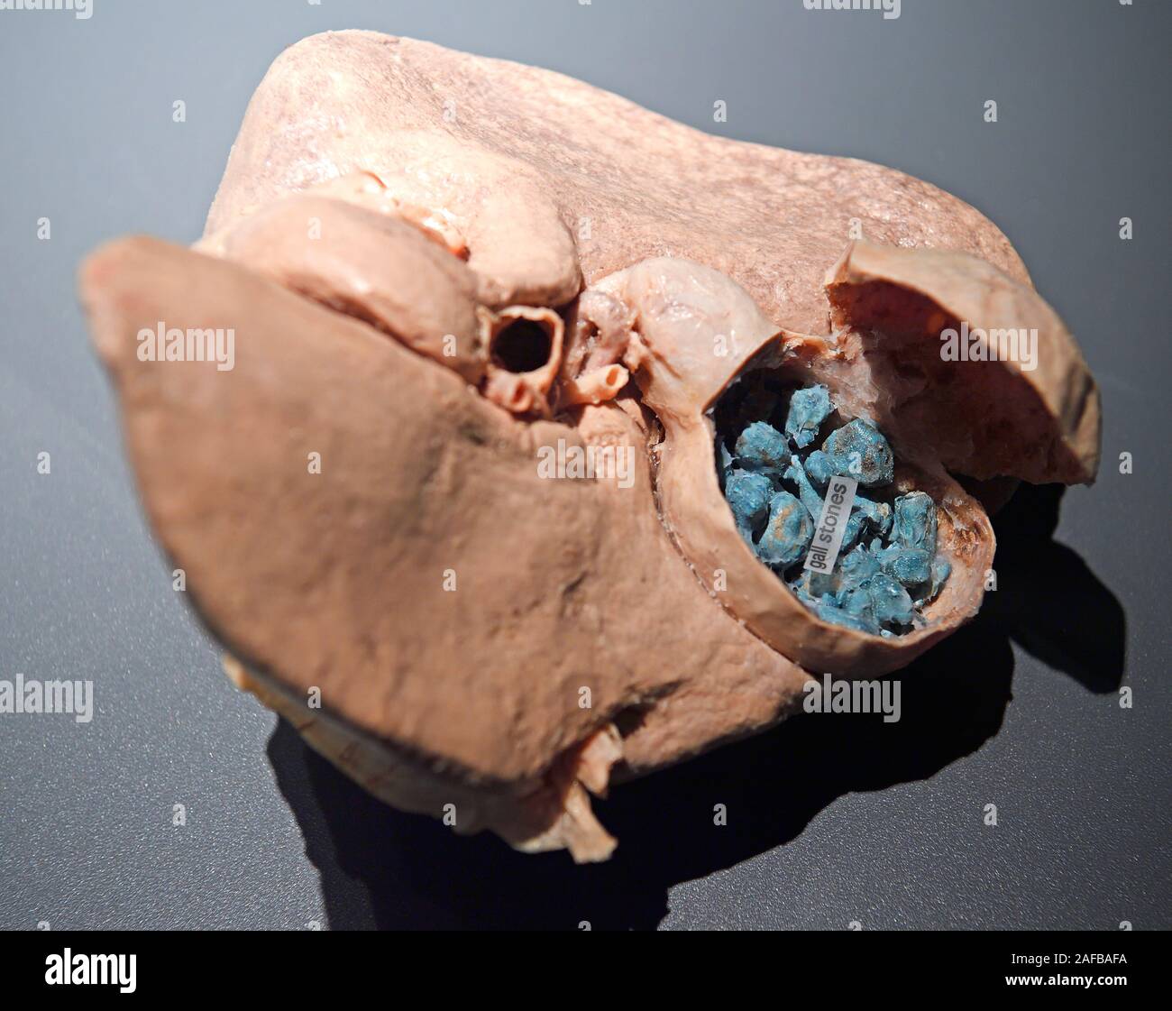 Präparat, Plastinat, Gallenblase mit Gallensteinen, Menschen Museum di Berlino, Deutschland Foto Stock