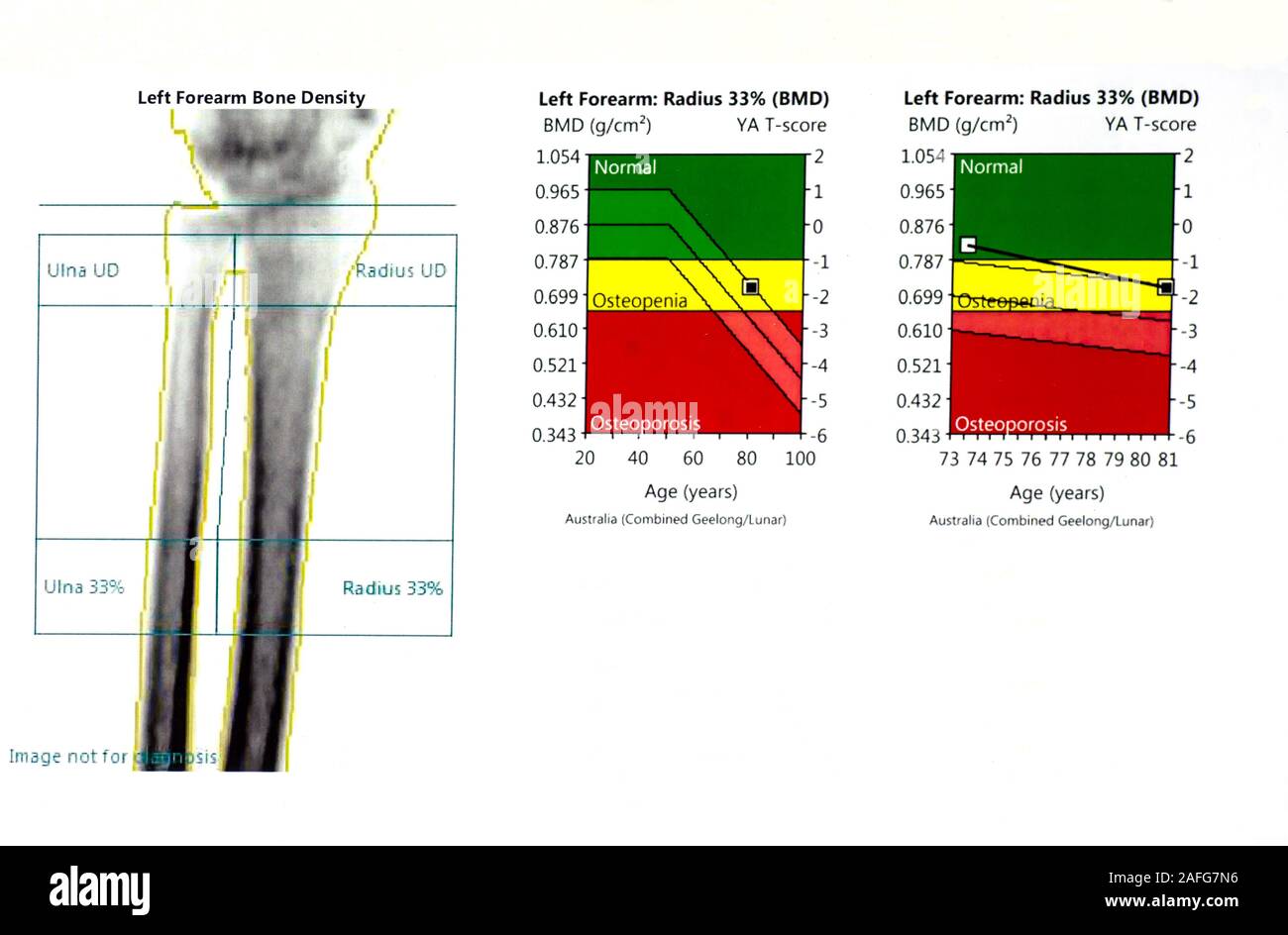 Grafico Della Densit Ossea Immagini E Fotografie Stock Ad Alta 