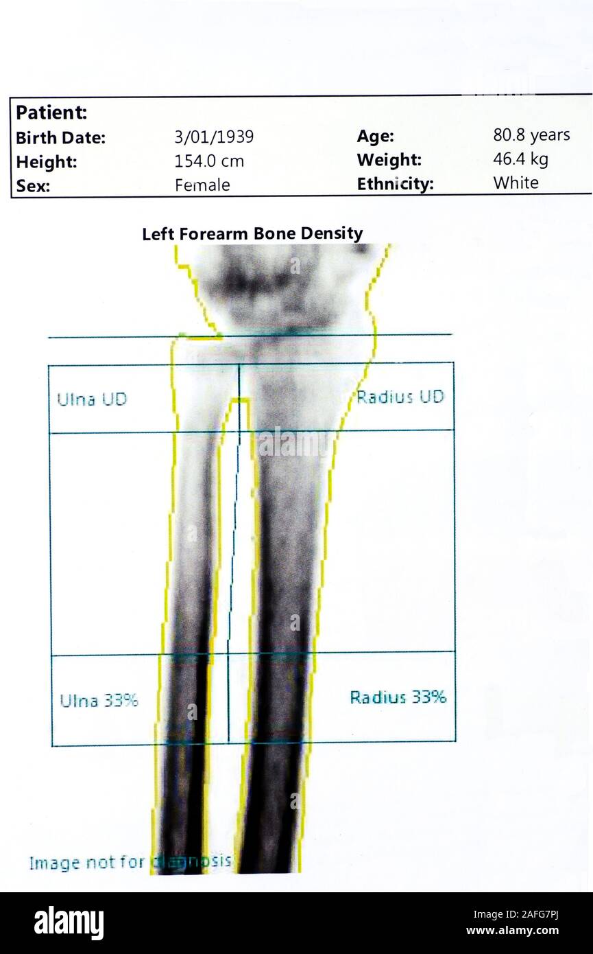 La densità ossea scansione dell'avambraccio di un paziente di sesso femminile di età compresa tra i 80. Foto Stock