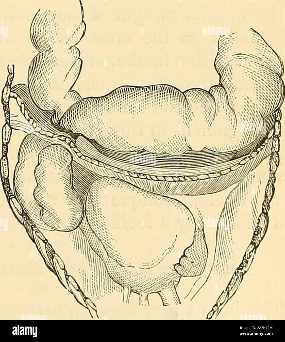 . I principi e la pratica della chirurgia. ceration causato da un sforzo greatmuscular, o da una forza di schiacciamento. La sua causa più frequente è la con-malformazione genitale o difetto del diaframma, e questa condizione isfound molto più spesso nelle femmine rispetto ai maschi. L'apertura di fuga è di solito su lato sinistro, sometimesmedian, e raramente sul latodestro side. In tre casi si è oc-indurita su entrambi i lati simultaneamente-neously. Lo stomaco e trans-versetto del colon, omento, piccole-testines, milza e fegato theviscera sono più spesso coinvolti.Essi sono raramente oggetto com-pletamente da peritonaeum o pleura.Il sy Foto Stock