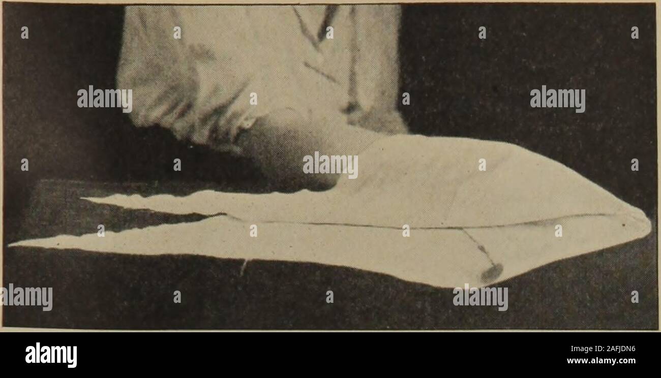 . Igiene personale e Attività infermieristica a domicilio : un testo pratico per le ragazze e le donne per la casa e per l'uso scolastico. Lussazioni e fratture, e bende 233. Fig. 71. Che stabilisce la mano in un bendaggio triangolare. Fratture. Una frattura può essere semplice, composto, sminuzzato,l'impatto o greenstick. Una frattura semplice è quella in cui l'osso è rotto, ma incui non vi è alcuna apertura attraverso la pelle. Un composto frattura è uno in cui la pelle viene perforata da theend dell'osso fratturato. Una comminuta frattura è uno in cui l'osso è rotto intomany pezzi. Un frattura interessata è quella in cui le due estremità del bon Foto Stock