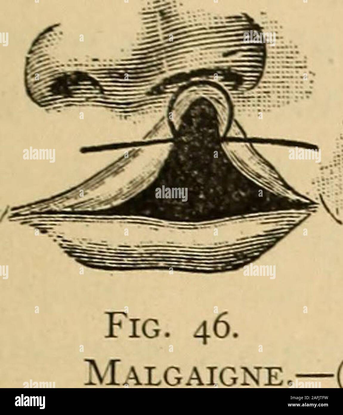 . Trattamento post-operatorio; un epitome della gestione generale del post la cura e il trattamento dei casi chirurgici come praticato da eminenti americana ed europea e chirurghi. solo carenti nella linea mediana, ma carente,come una regola, ovunque. È eccessivamente breve, e dopo la maggior parte successfuloperation è incerto se il palato è sempre così completamente ripristinata chenon è in grado di intercettazione della bocca dal passaggio nasale. L'operazione, tuttavia, pone il paziente in una posizione di articolazione attainnormal. Essa gli permette di essere educati a parlare naturalmente.Questa istruzione è noioso, un Foto Stock