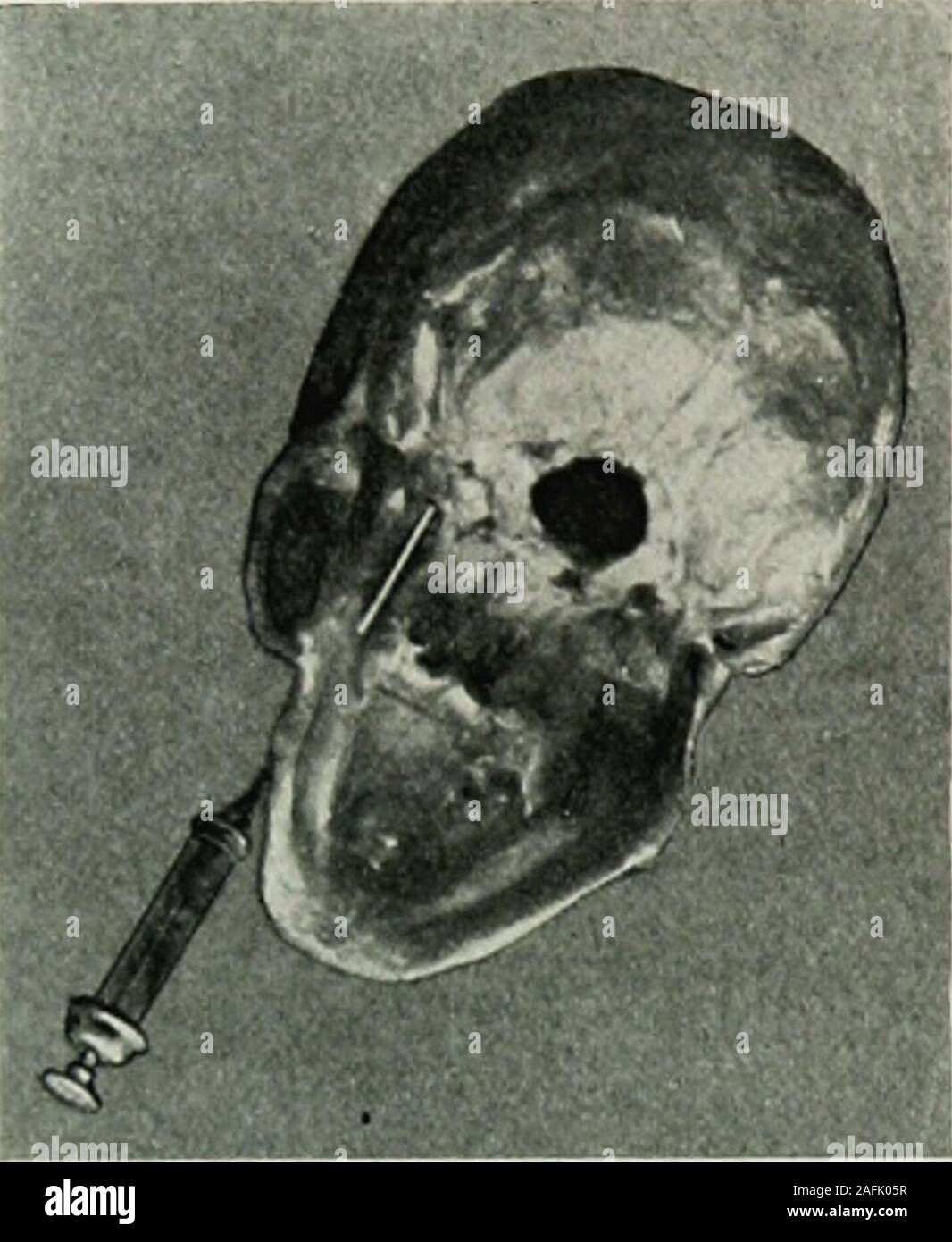 . Locale e anestesia regionale : con capitoli su spinale, epidurale, paravertebral e parasacral analgesia e su altre applicazioni locali e regionali di anestesia per la chirurgia dell'occhio, orecchio, naso e gola, e alla pratica dentistica. ranch dell'interno dell'arteria mascellare sotto thenerve: io, nervo zigomatico; 2, infra-arteria orbitale; 3, int. arteria mascellare; 4, mandibularnerve; 5 nervo mascellare; 6, ganglio sphenopalatine; 7, oftalmica nervo; 8, int. carotidart.; 9, ganglio gasserian. (Dopo Testut e Giacobbe.) area di anestesia cutanea, che permette una variazione della foratura Foto Stock