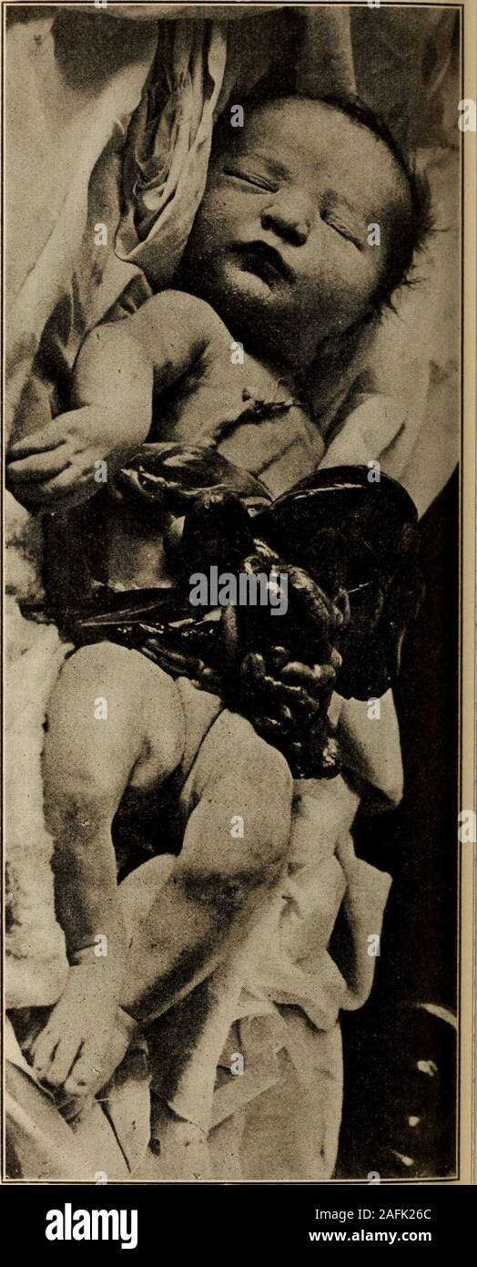 . Ufficiale della Società Medica del New Jersey. su della cordicella, whichwas composta di amnion con un innerlining del peritoneo parietale, era foundto contengono tutti i visceri mobili di theabdomen, vale a dire, lo stomaco, piccole-testine, intestino crasso verso il basso per il begin-ning della sigmoide, grande omento, fegato andspleen. Comunicazione con il abdomi-nal cavità è stata stabilita da un stretto, roundopening ammettendo la punta dell'indice fin-ger ( vedere pinza pollice ). Il fissato ab-dominal visceri rimasti nell'addome,che è le ghiandole surrenali, reni, vescica andinternal gli organi genitali. Il fegato presen Foto Stock