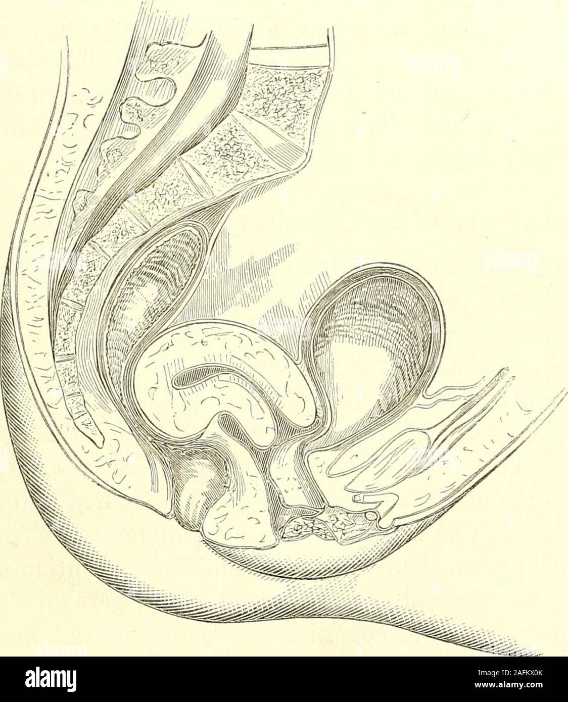 . La diagnosi di una patologia e il trattamento delle malattie delle donne compresa la diagnosi di gravidanza. mundus indietro, ma in retrover-sion questo è conseguente a tutto il canale uterino assuminga invece trasversale di una posizione verticale nella pelvi; whereasin retroflexion, la parte cervicale di questo canale possono trattenere prettynearly la sua normale direzione, il canale al di sopra di questa bruscamente la retroversione dell'utero non impregnata. 163 piegata all'indietro. Tra i due estremi di tutte le gradazioni forse assistito a. Inoltre i due sono spesso associati ; wherethere è retroversione, vi è usu Foto Stock