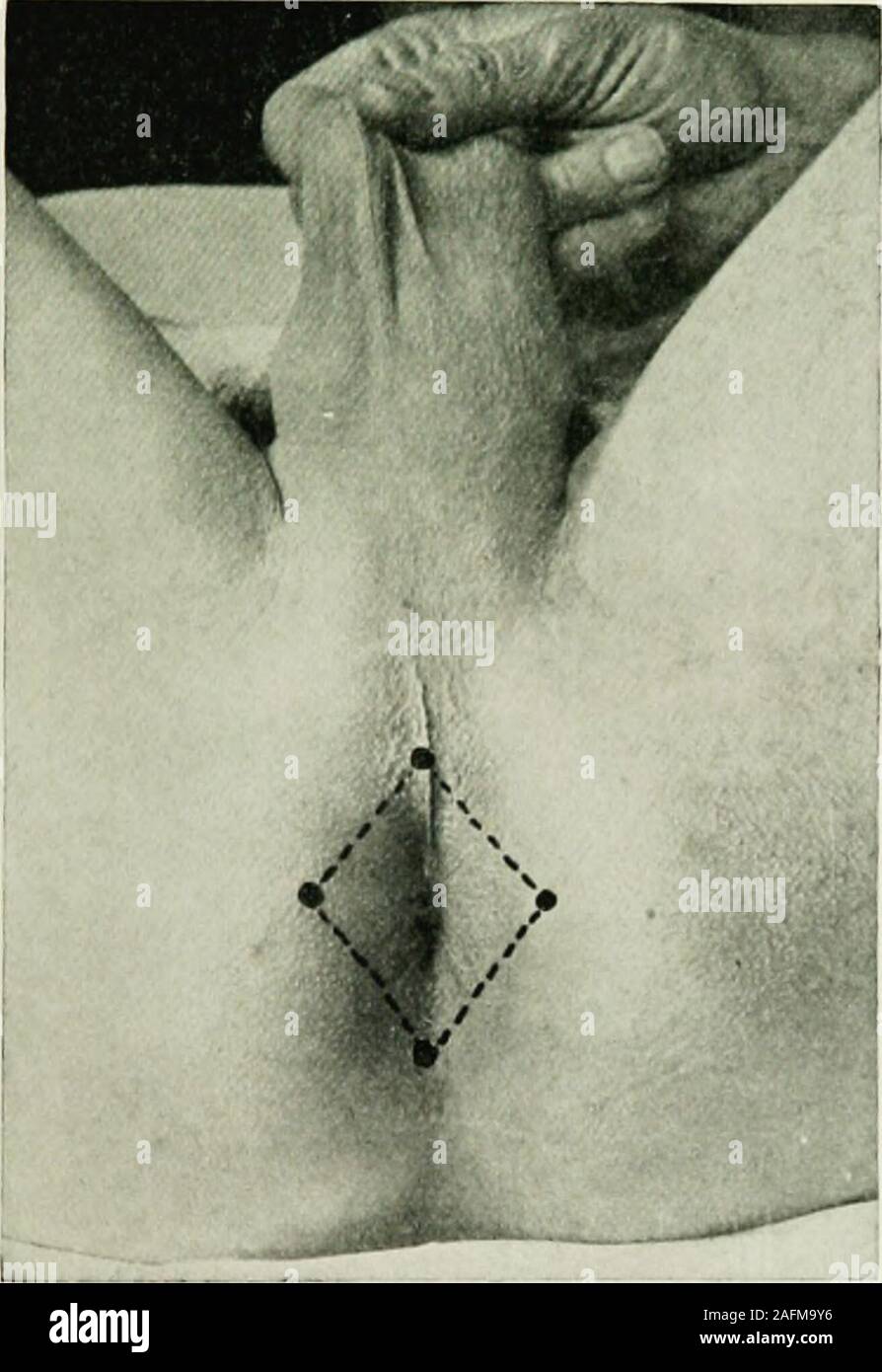 . Locale e anestesia regionale : con capitoli su spinale, epidurale, paravertebral e parasacral analgesia e su altre applicazioni locali e regionali di anestesia per la chirurgia dell'occhio, orecchio, naso e gola, e alla pratica dentistica. fect sur-gical anestesia. Questa tecnica è così semplice e rapida esecuzione che lo scrittore al-la maggior parte invariabilmente lo utilizza per tutte le operazioni in questa regione (emorroidi,fessura, prolasso, ecc.) in preferenza di una anestesia generale. I tessuti vengono prima infiltrato per via sottocutanea circa l'ano inil giunzione mucocutanea, come si vede in Fig. 105. È meglio t Foto Stock