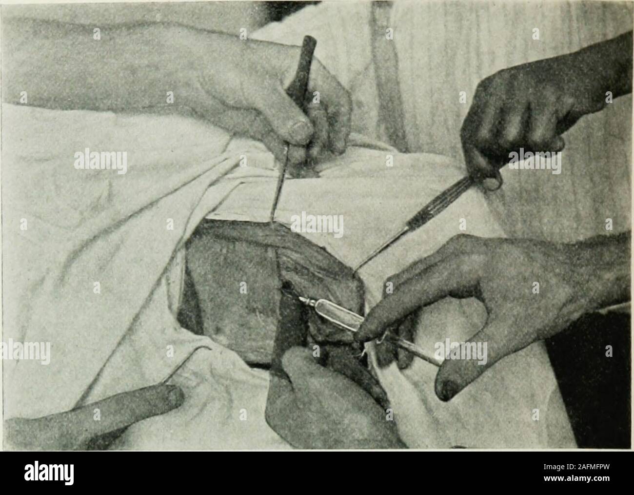 . Locale e anestesia regionale : con capitoli su spinale, epidurale, paravertebral e parasacral analgesia e su altre applicazioni locali e regionali di anestesia per la chirurgia dell'occhio, orecchio, naso e gola e per studio dentistico. Fig. S4.-1, Iliohypogastric nervo; io, ilio-nervo inguinale; 3, funicolo spermatico; 4, hernialsac dissecata libera. Il nervo genitocrural non è visto come si trova all'interno del cavo su itsposterior aspetto. Omento può essere resecato, se necessario, senza dolore.1 un dito èora passati nella cavità attraverso il collo del sacco, e due piccole orthree hypodermics del s Foto Stock