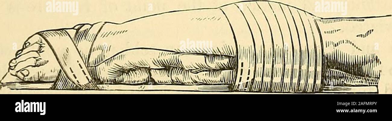 . I principi e la pratica della chirurgia. che il piede è ritorto violentemente verso l'esterno e a volte la stessa ankleis dislocato, o piuttosto l'astragalo viene ruotato su tibia.Questo è stato generalmente noto tra i chirurghi come Potts frattura. Nel caso in cui il piede è stato gettato verso l'esterno con sufficiente vigore todislocate caviglia o ruotare l'astragalo nella sua presa, non c'è alcune volte, che accompagna la frattura del perone, una frattura del mal-leolus internus; o, come sempre più spesso accade, un distacco di someportion del laterale interna da legamenti del malleolo internus.W Foto Stock