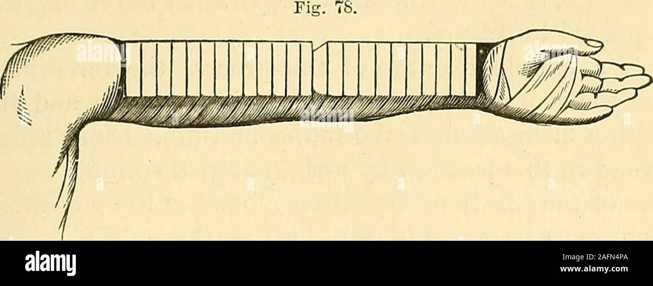 . I principi e la pratica della chirurgia. Frattura del processo Olecranon. Fratture dell'ulna. 279 quattro pollici sotto la spalla al polso e della larghezza del armin la sua parte più ampia. In un punto a circa tre pollici al di sotto del olecranonprocess una tacca è effettuata su entrambi i lati del fissatore, per ricevere theoblique giri del rullo e impedirne lo scorrimento della stecca. Medicazione per una frattura del processo Olecranon. È quindi ricoperto su un lato di uno strato di ovatta di cotone, così distribuiti come tomeet irregolarità dell'arto, e poi il tutto è racchiuso in acover o sacco. Non è Foto Stock