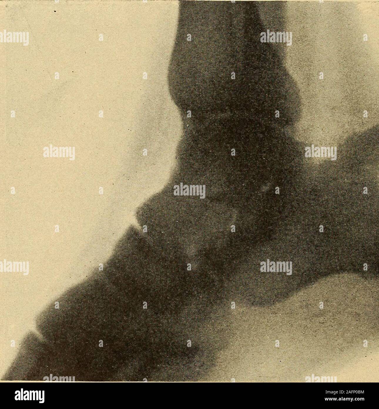 . Una pratica Treatise on fratture e dislocazioni. Fr;Utui con il risultato di ])r(Hhicino iractuiv del til)iila, come deseriheil su ]&GT;aue452 o rottura della (t(^rno lioauuMit hiteral o avulsione oi un seale 462 fratture di ossa dal lato del calcagno dove il legamento è inserito,o frattura del sustentaculum tali. Con la prima di queste non abbiamo qui a trattare. Un caso di avulsionof una scala di osso è venuto sotto la mia osservazione al Presbyterian Hos-pital nel 1880; il paziente era caduta da un'altezza di dieci piedi, strikingupon il suo piede sinistro. Ho visto su di lui il successivo Foto Stock