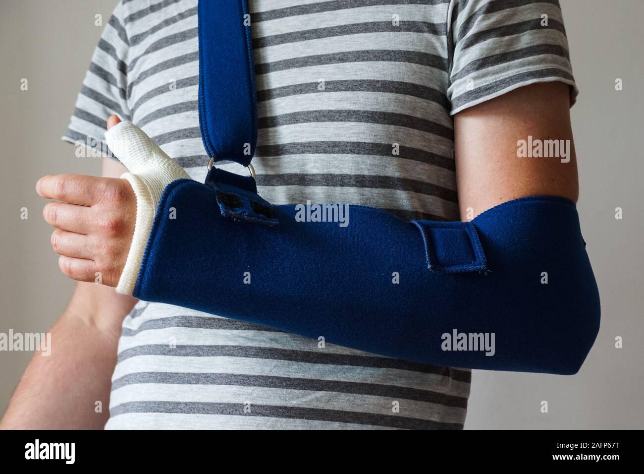 Uomo con il calco in gesso sul pollice rotto,rotture di polso e mano rotti sul braccio imbracatura Foto Stock