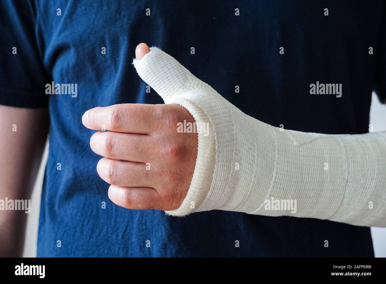 Uomo con il calco in gesso sulla mano rotti, rotto il pollice,polso rotto Foto Stock
